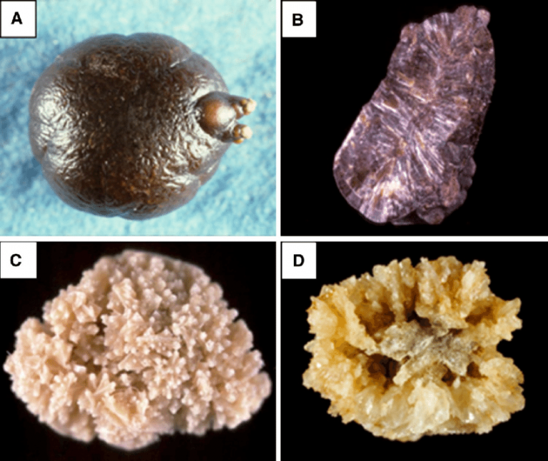 Калциеви камъни Сдружение на пациентите с бъбречнокаменна болест